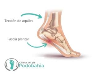 fascitis_plantar