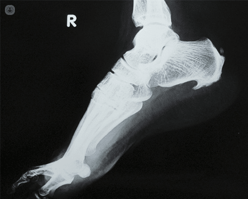 espolon calcaneo_facitis plantar